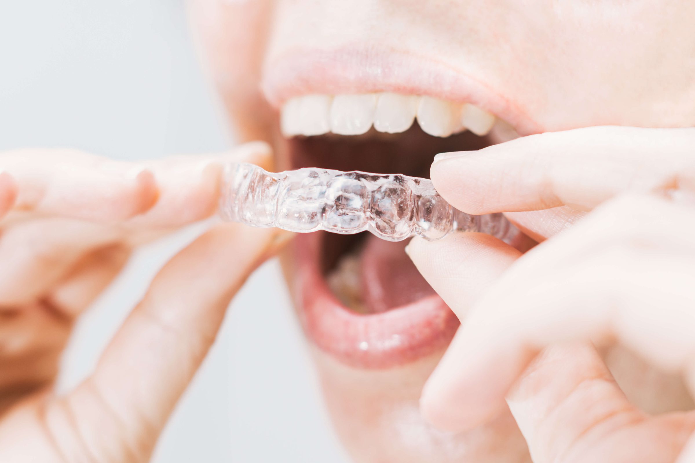 Patient gently inserting her new clear aligners.