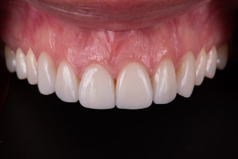 Picture of a patient's teeth after getting Porcelain Veneers from our cosmetic dentist in Irvine.