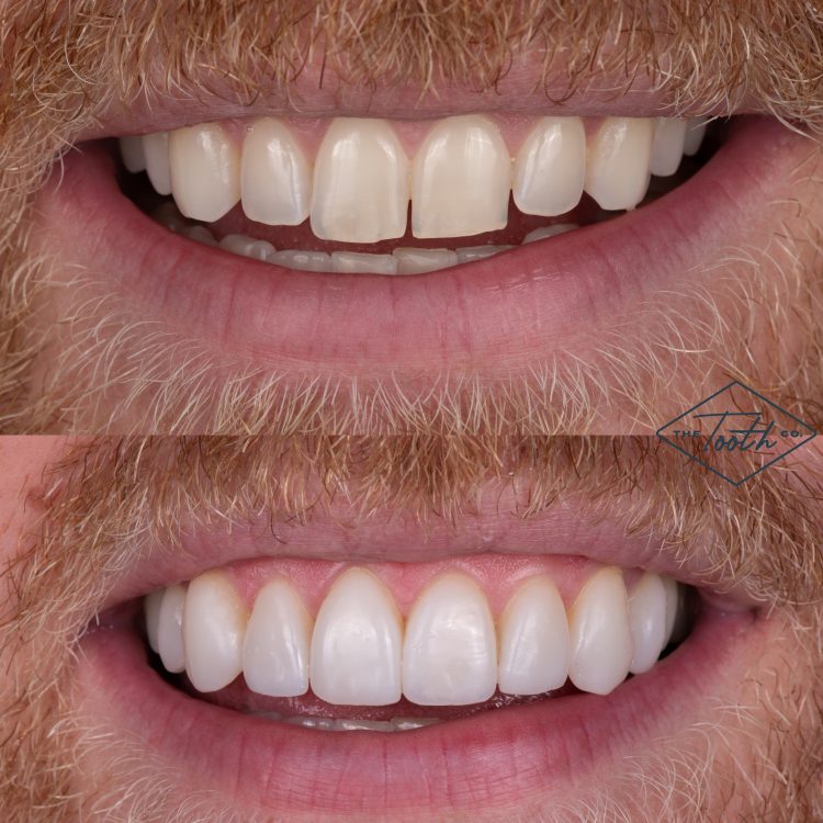 A before and after of 3D printed veneers in Orange County, CA