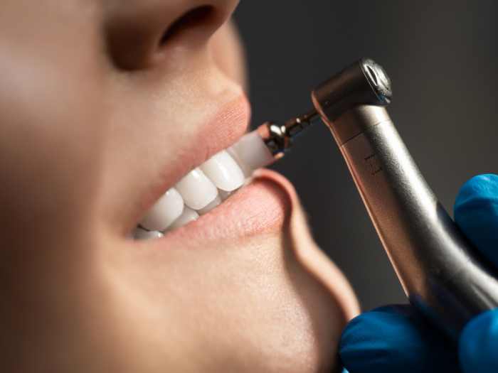 A patient getting a dental cleaning in Irvine, CA
