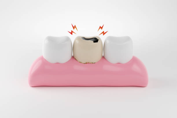 a decayed tooth in between two healthy teeth