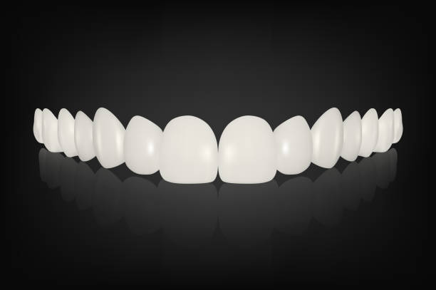 a digital illustration of veneers
