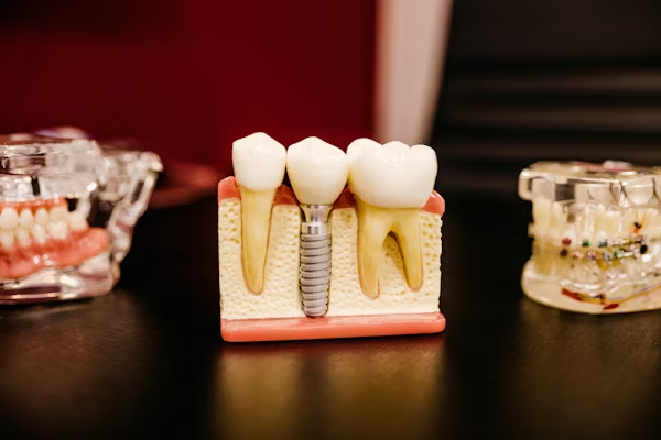 a dental implant in a dental model