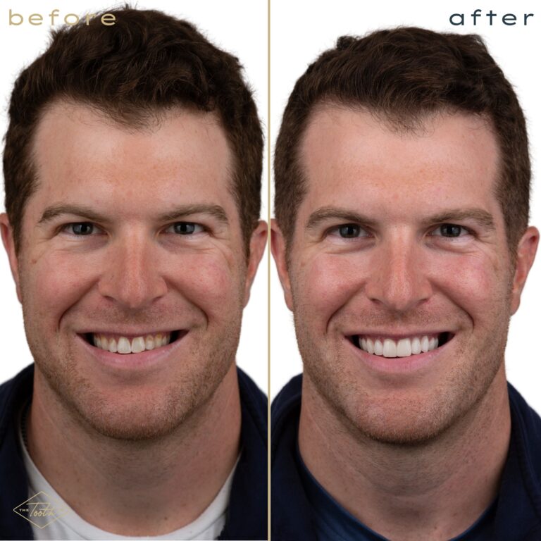 Before and after smile transformation portrait