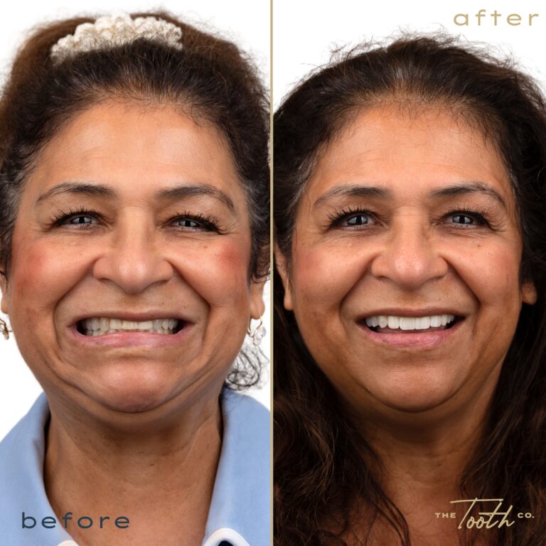 Before and after smile transformation portrait