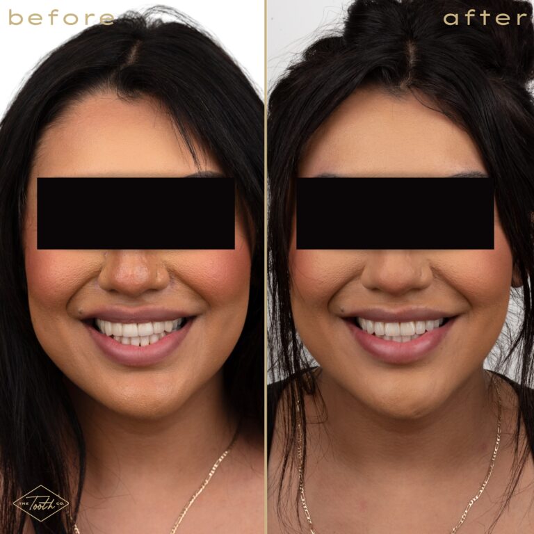 Before and after smile transformation portrait