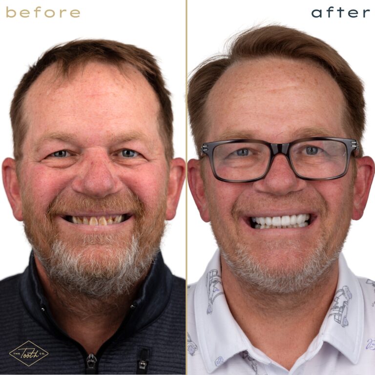 Before and after smile transformation portrait