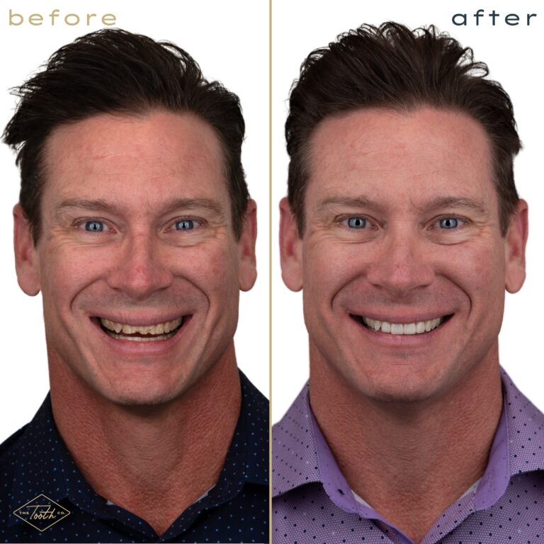 Before and after smile transformation portrait