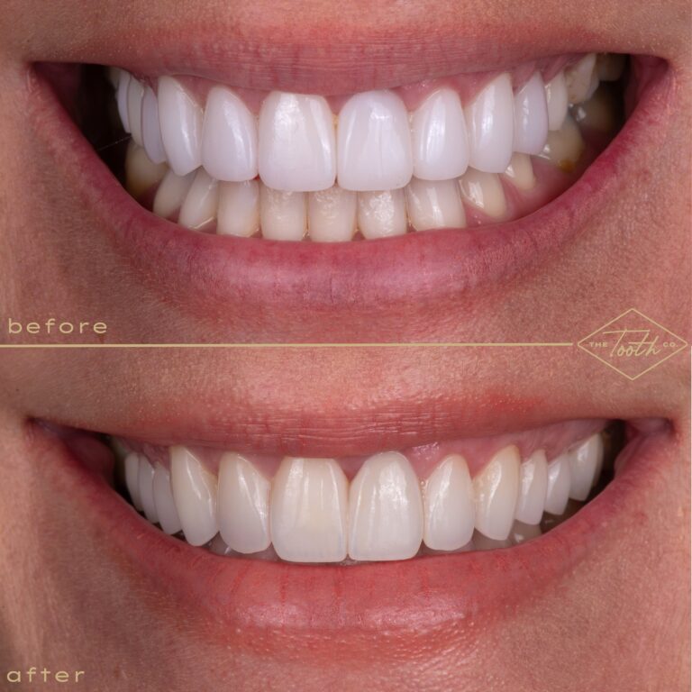 Before and after smile close-up