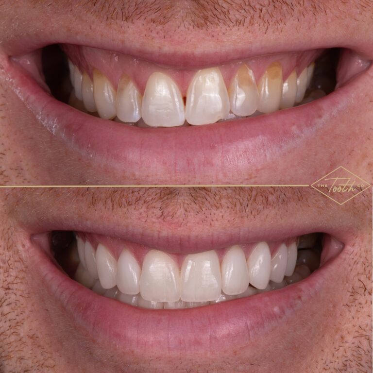 Before and after smile close-up
