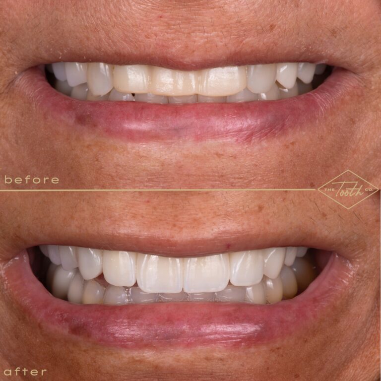Before and after smile close-up
