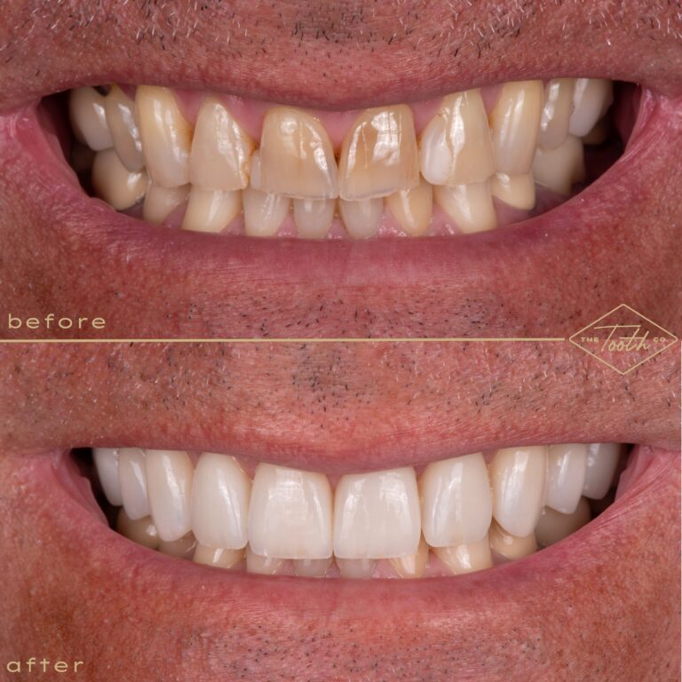 Before and after smile close-up