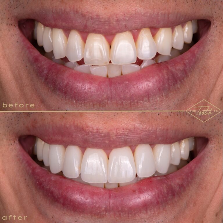 Before and after smile close-up