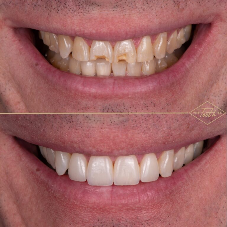 Before and after smile close-up