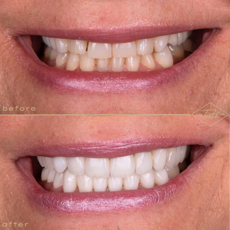 Before and after smile close-up