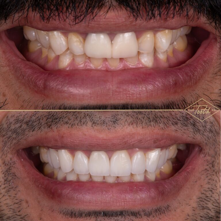 Before and after smile close-up