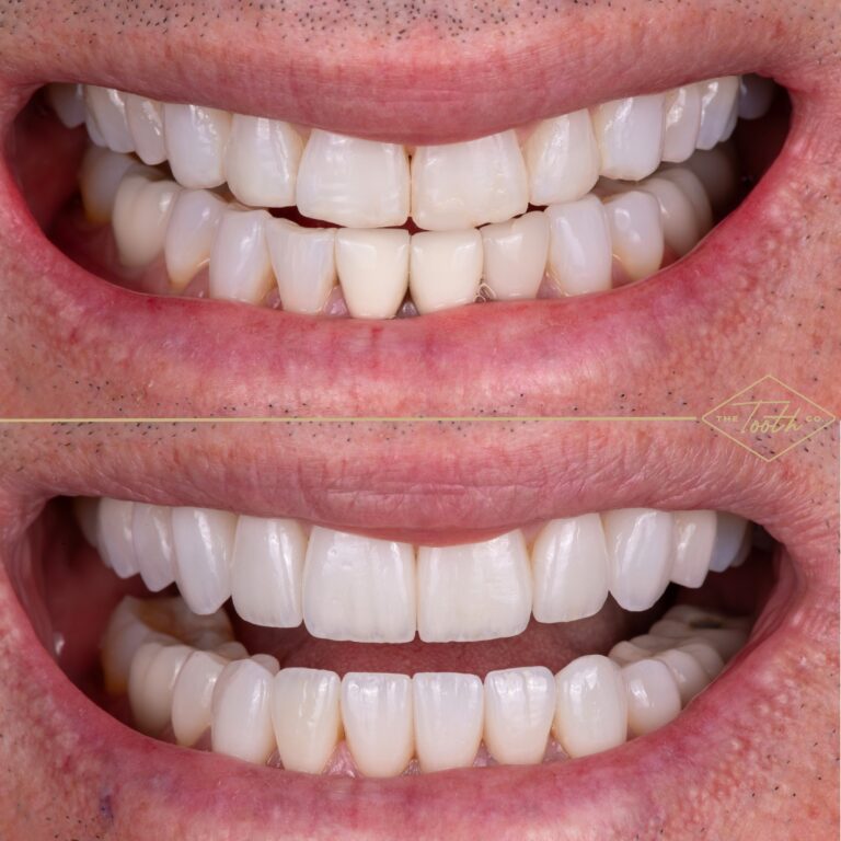Before and after smile close-up