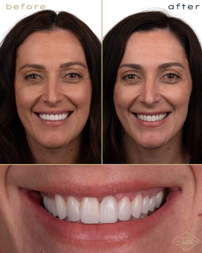 Before and after smile transformation portrait