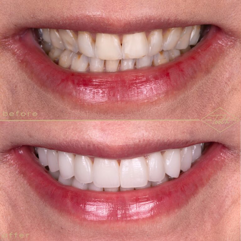 Before and after smile close-up