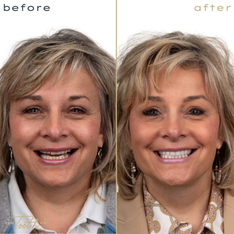 Before and after smile transformation portrait