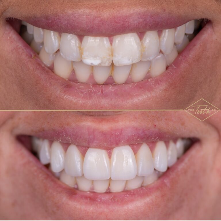 Before and after smile close-up