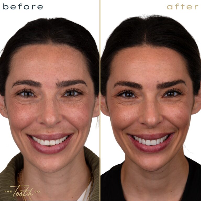 Before and after smile transformation portrait