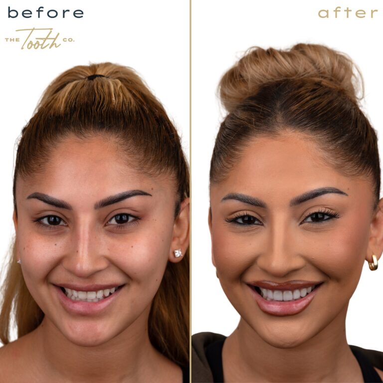 Before and after smile transformation portrait