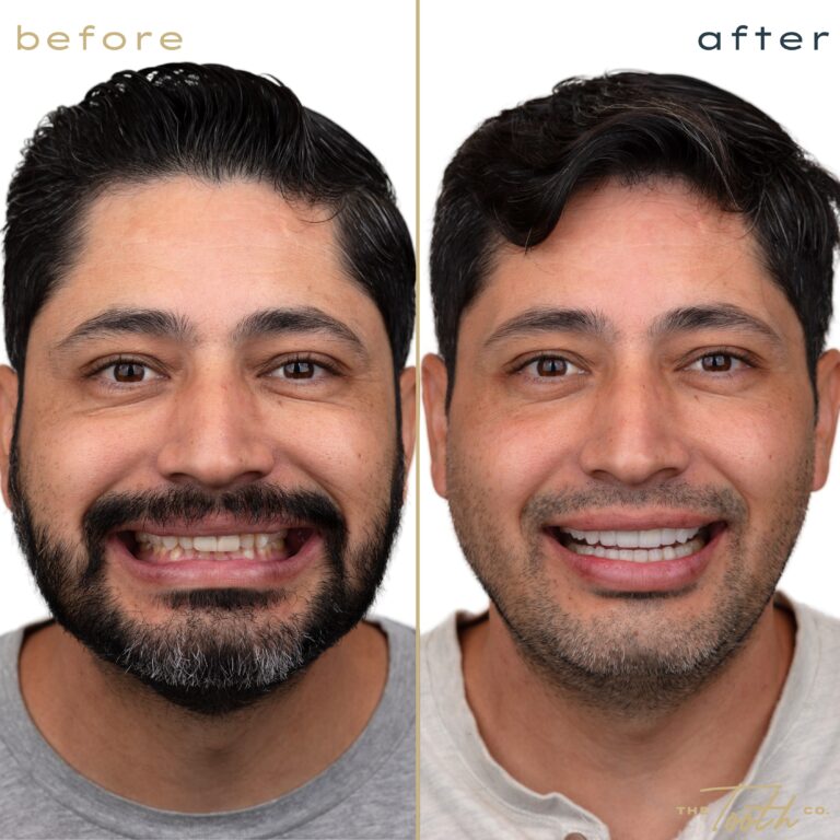 Before and after smile transformation portrait