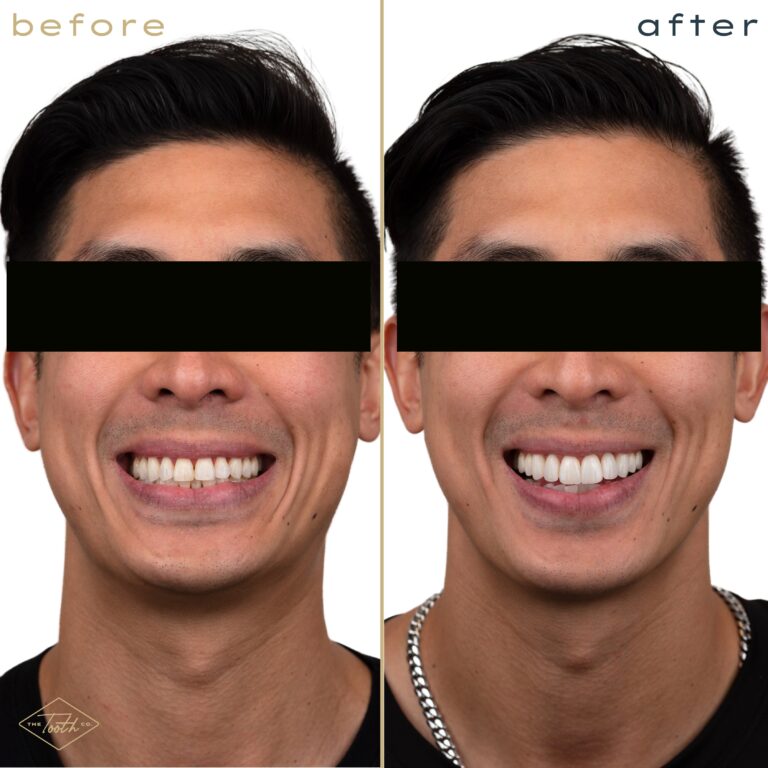 Before and after smile transformation portrait