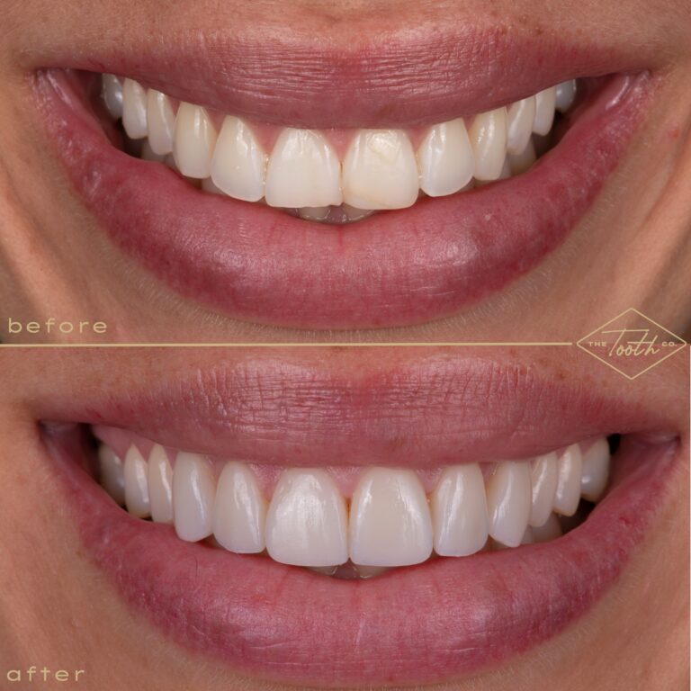 Before and after smile close-up