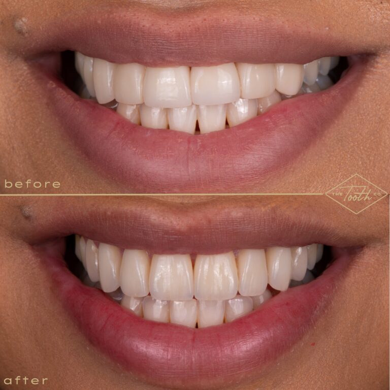 Before and after smile close-up