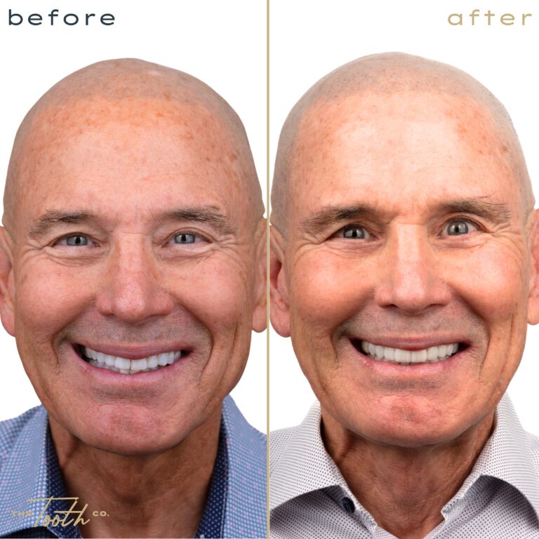 Before and after smile transformation portrait