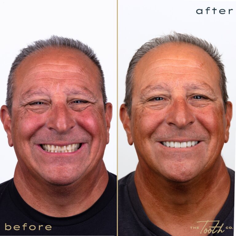 Before and after smile transformation portrait