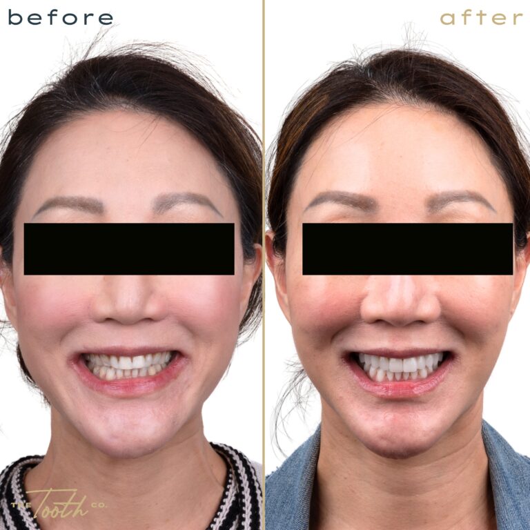 Before and after smile transformation portrait