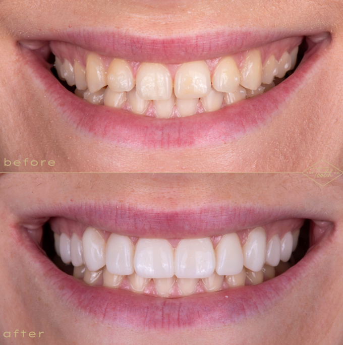 Close-up front view of teeth before and after composite veneers.