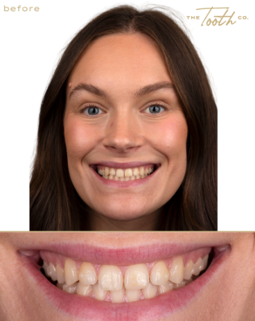 Front view of a smile before composite veneer treatment.