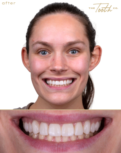 Front view of a smile after composite veneer treatment.