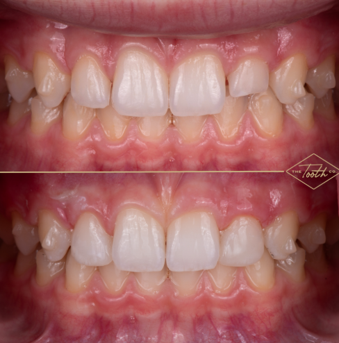 Retracted front view of teeth before and after composite bonding on the lateral incisors.