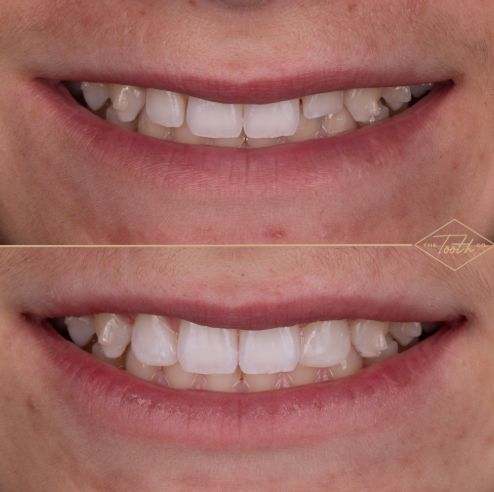 Front view of a smile before and after composite bonding on the lateral incisors.