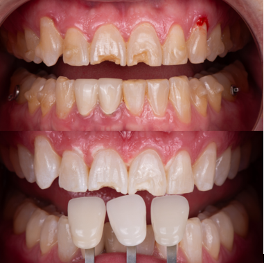 Front views of natural teeth before and after KöR whitening.