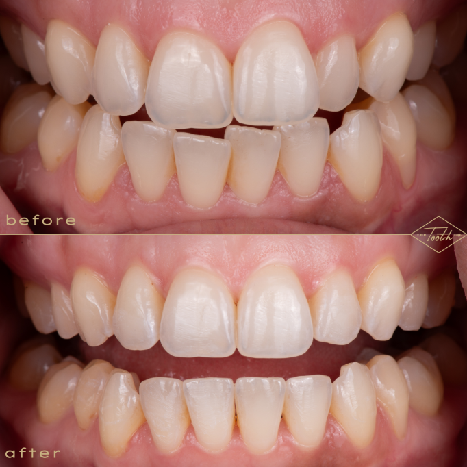 Front views of teeth before and after Invisalign treatment.