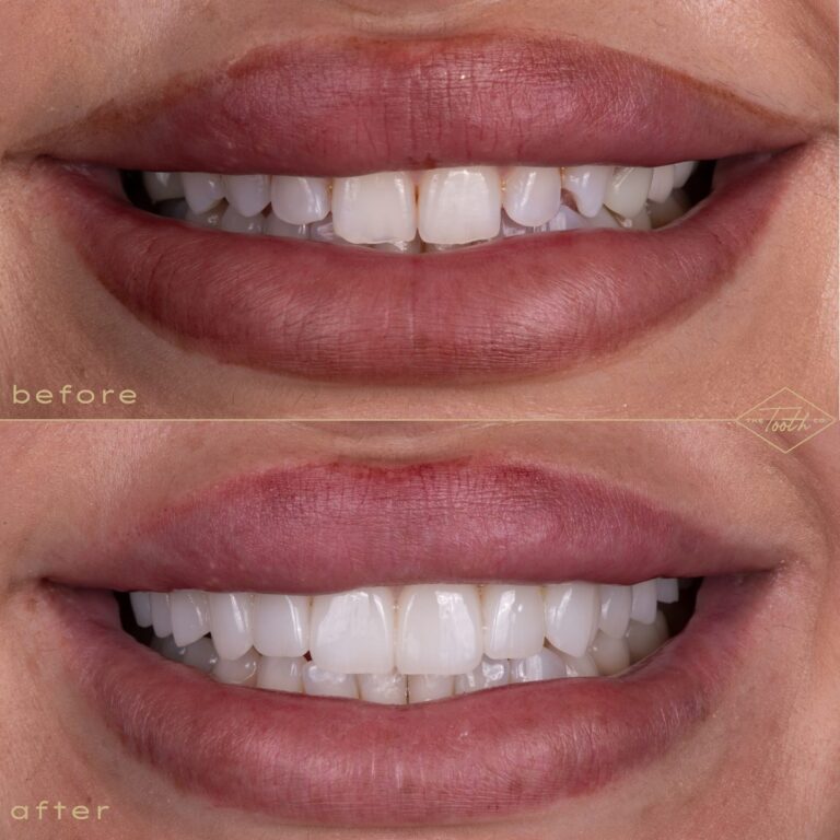 Close-up of teeth before and after porcelain veneers in Irvine, CA