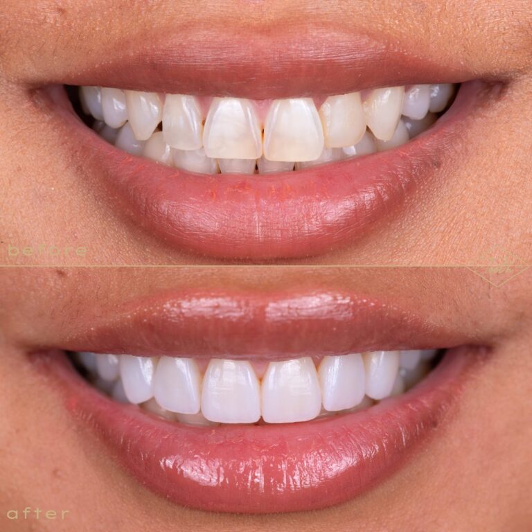 Close-up of a smile before and after veneers at The Tooth Co.