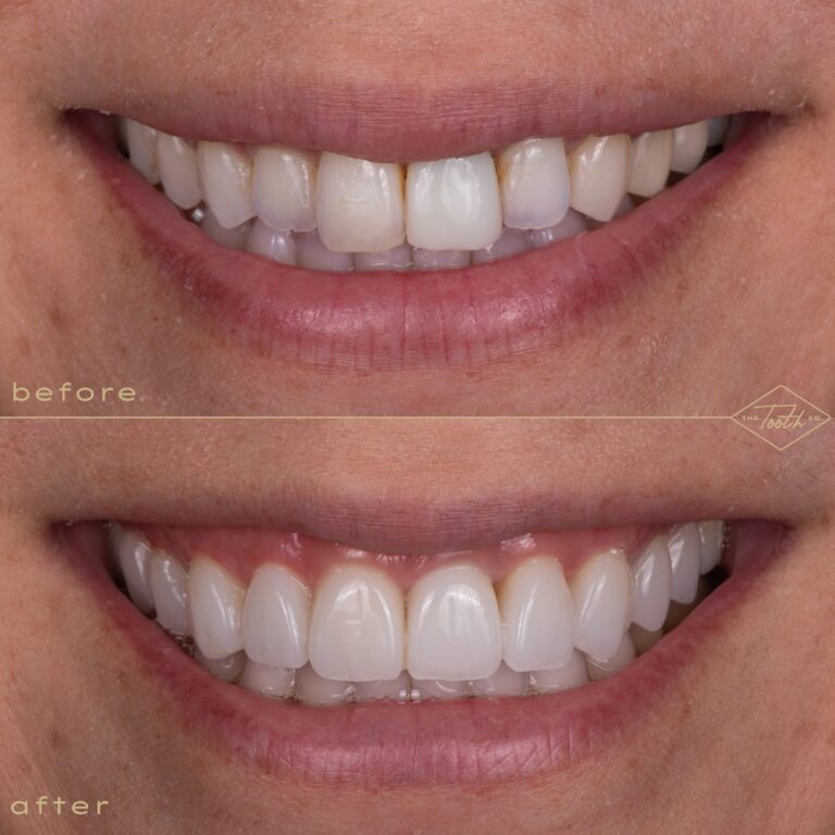 Close-up of a smile before and after porcelain veneers, Irvine cosmetic dentist
