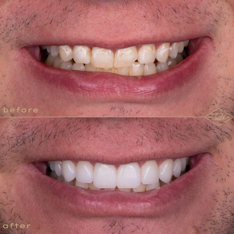 Close-up of worn, uneven teeth before and after veneers in Irvine, CA