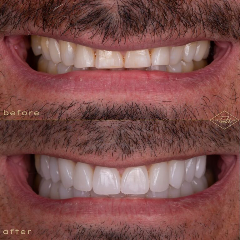 Close-up of a smile before and after veneers at The Tooth Co. in Irvine
