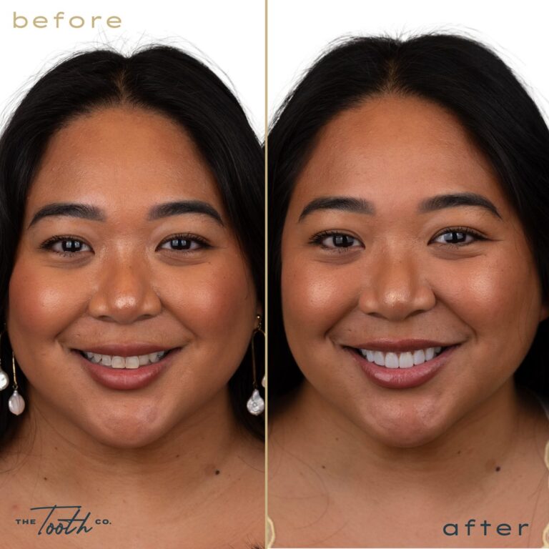 Before and after smile makeover on a woman at The Tooth Co. in Irvine, CA