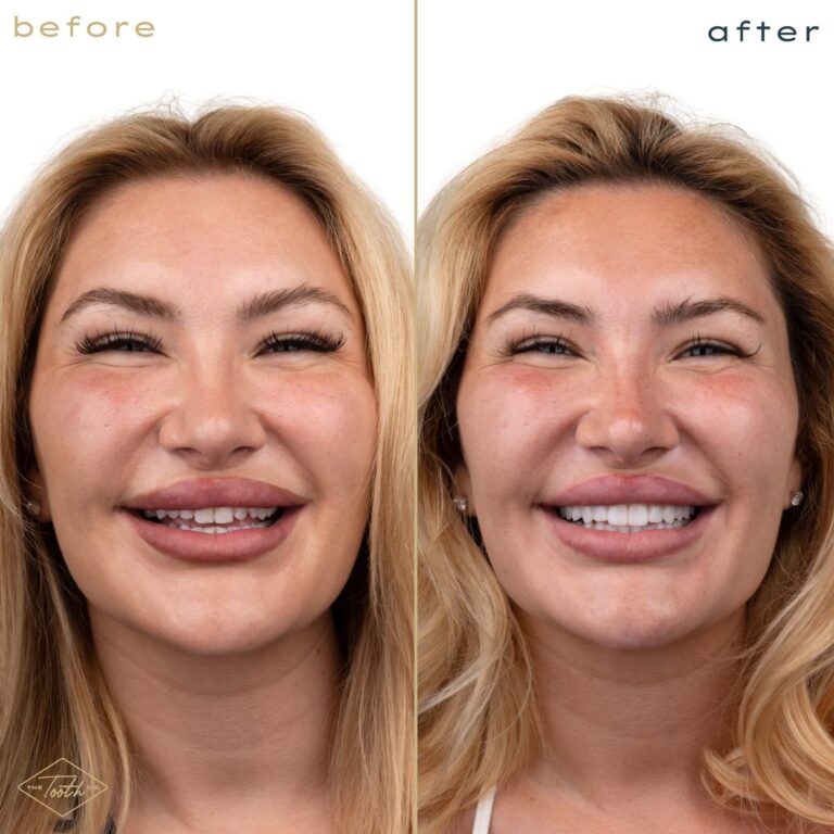 Before and after smile makeover on a woman with blonde hair, Irvine cosmetic dentist