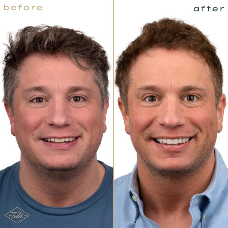 Before and after smile makeover on a man at The Tooth Co. in Irvine, CA