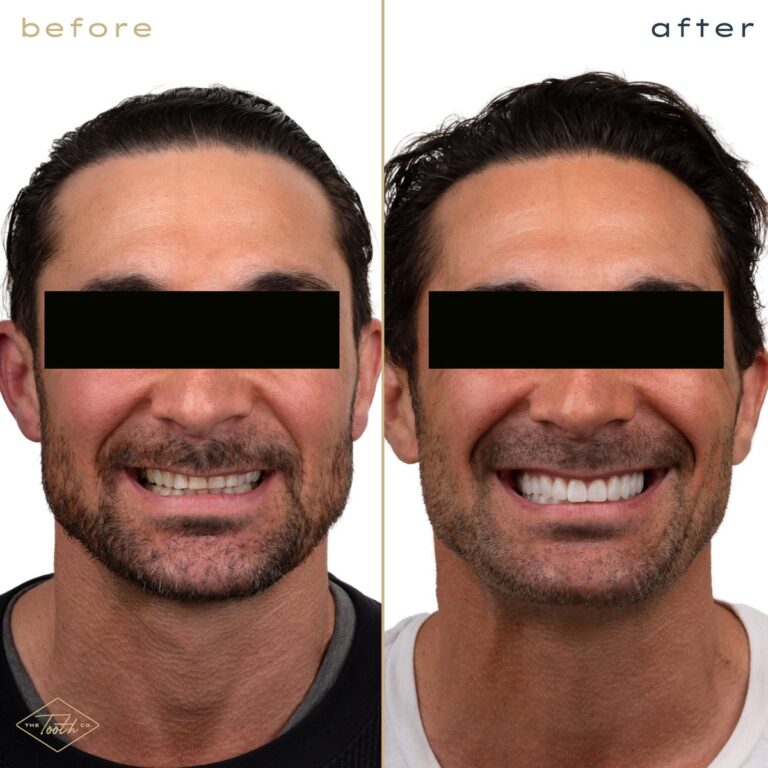Before and after smile transformation on a man, cosmetic dentistry in Irvine, CA